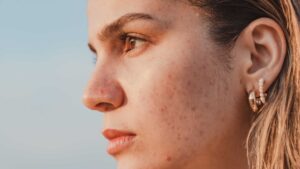 Visage avec de l'acné