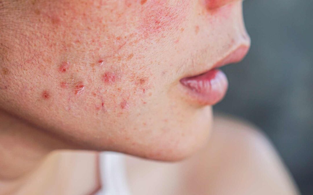 Remèdes naturels pour combattre l’acné : Les solutions douces et efficaces pour une peau nette avec Clean & Clear, La Roche-Posay, etc.