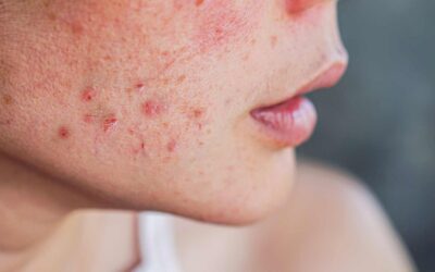 Remèdes naturels pour combattre l’acné : Les solutions douces et efficaces pour une peau nette avec Clean & Clear, La Roche-Posay, etc.
