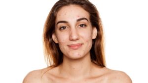 Visage avec de l'acné