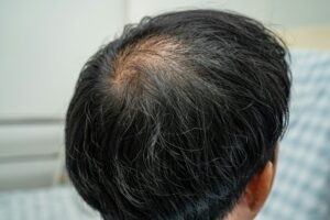 perte cheveux homme
