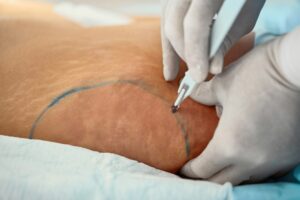 liposuccion